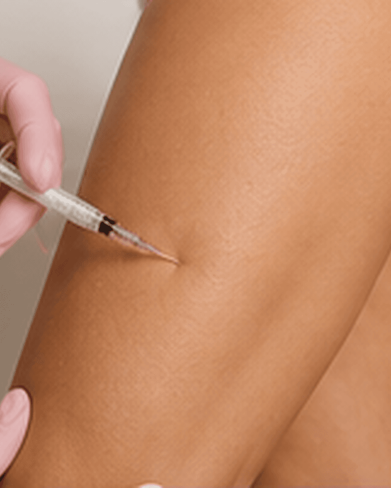 Bioestimulador de Colágeno Corporal