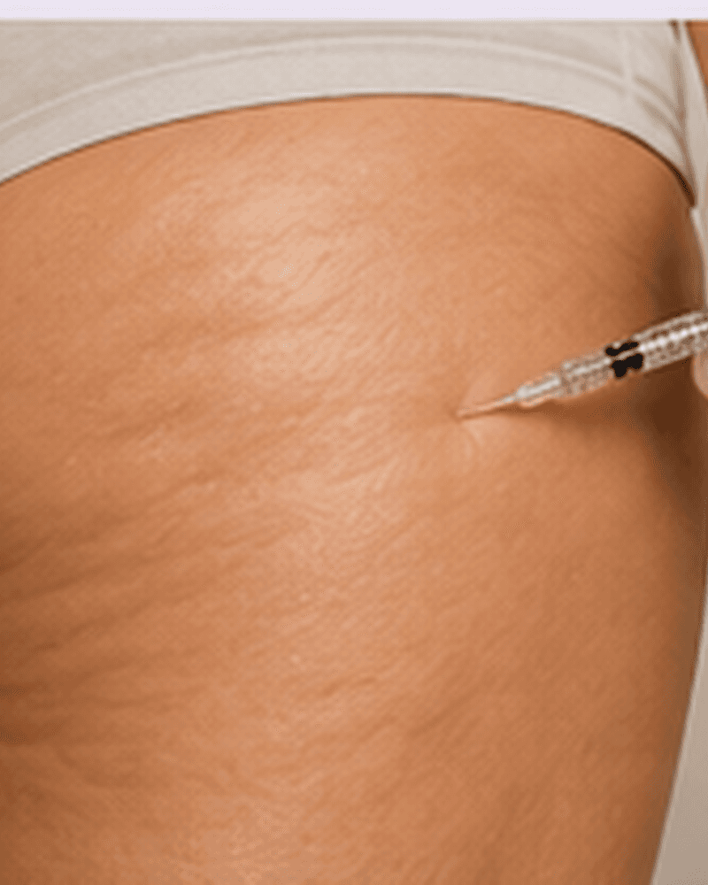 Intradermoterapia para Celulite