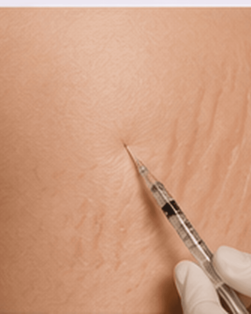 Intradermoterapia para Estrias